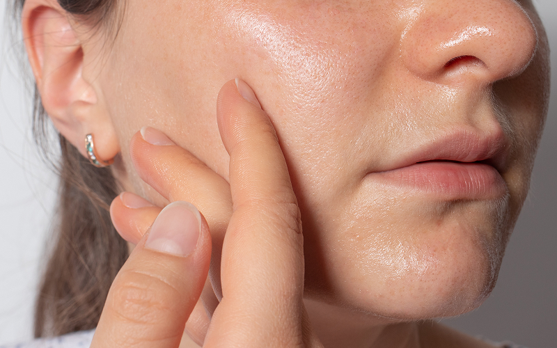 Image of a person with oily skin